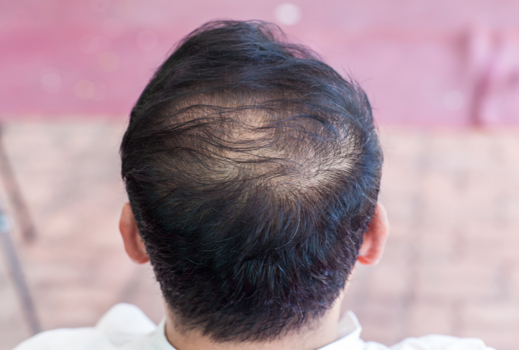 Hair loss treatment