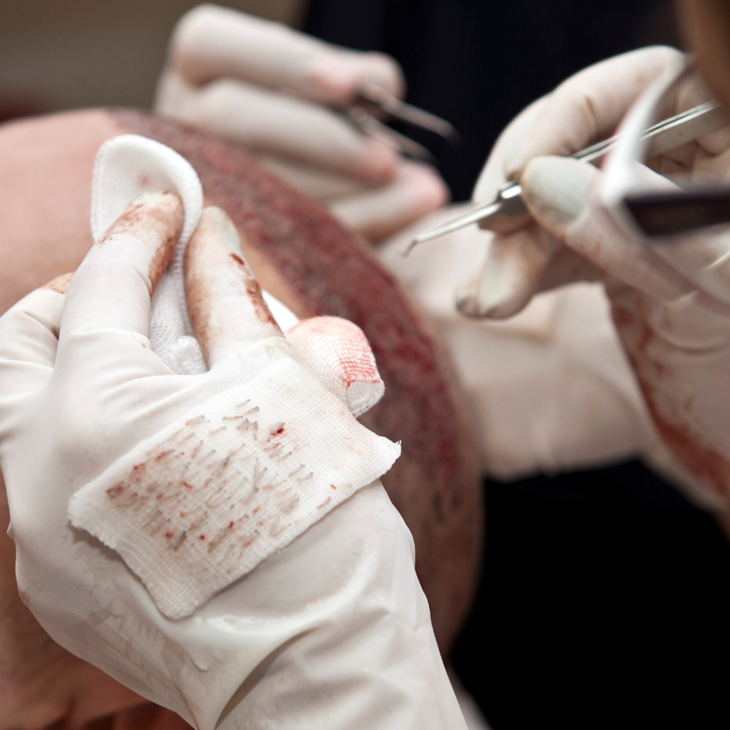 Hair Transplantation