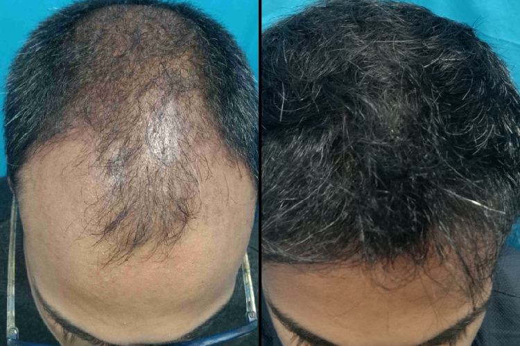 hair-transplant-bf